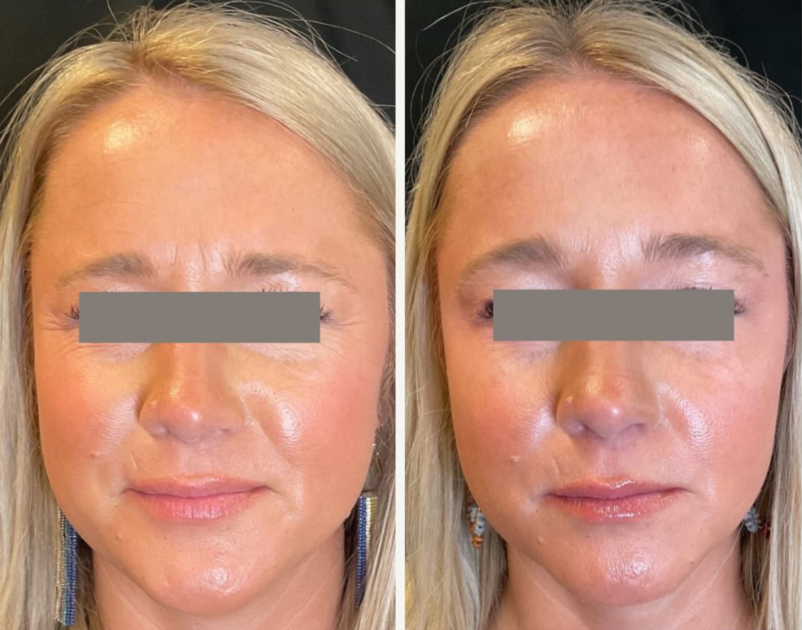 Dysport patient before & after