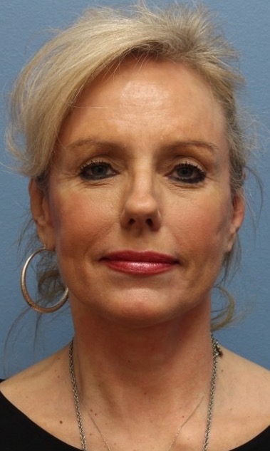 Facelift Before & after