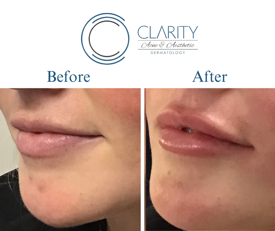 lip fillers before & after