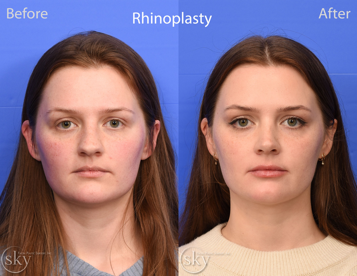 rhinoplasty before and after