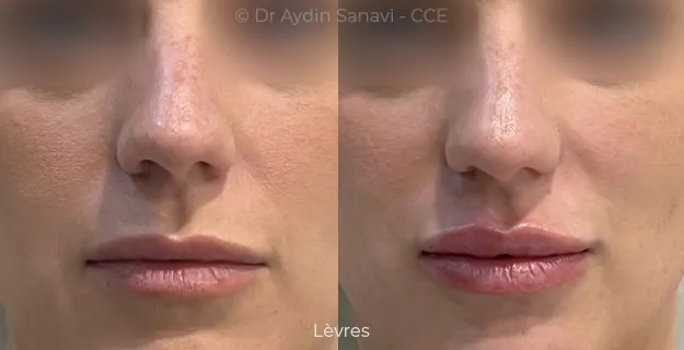 Avant/Après traitement capillaire