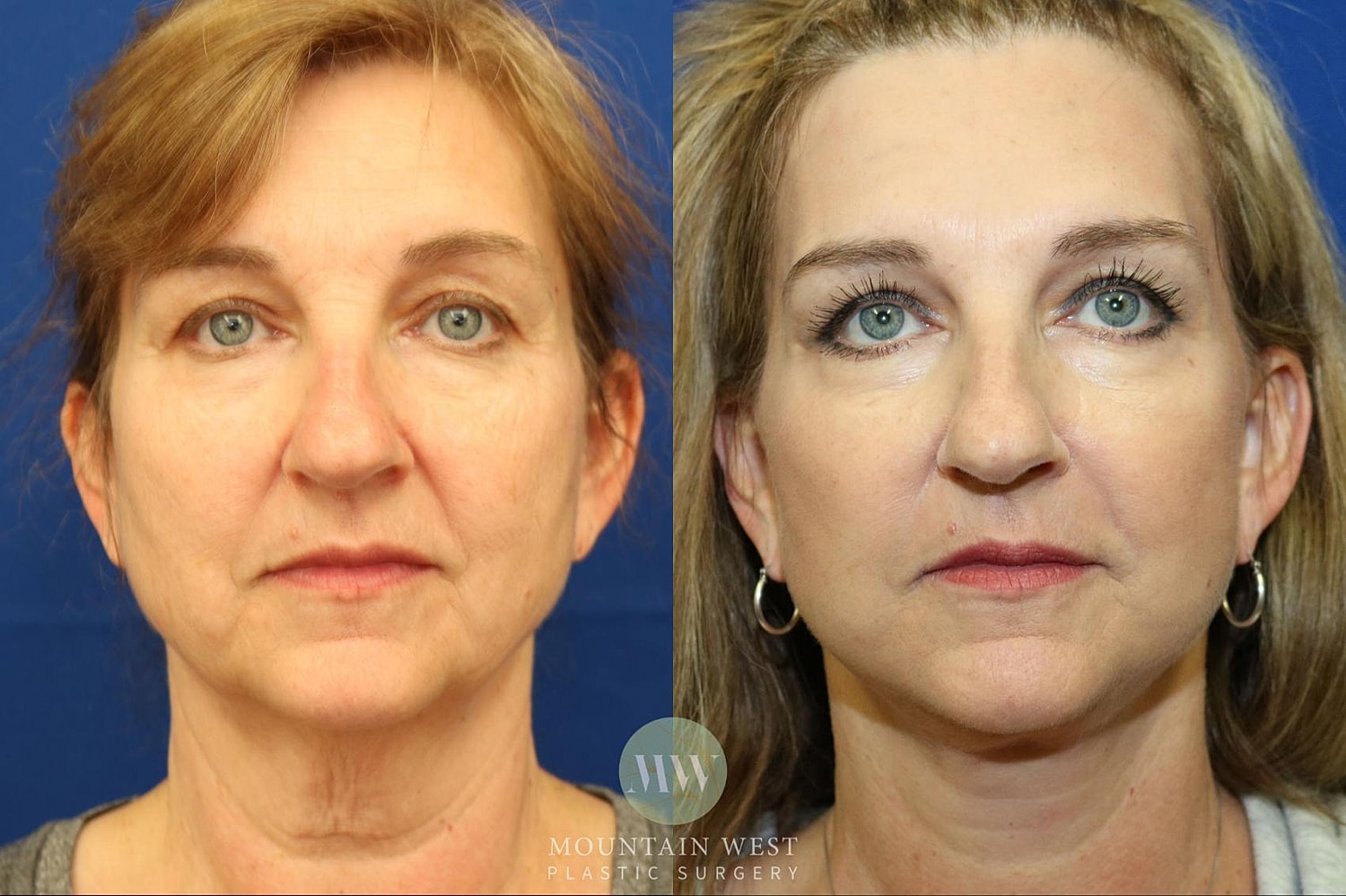 facelift before and after
