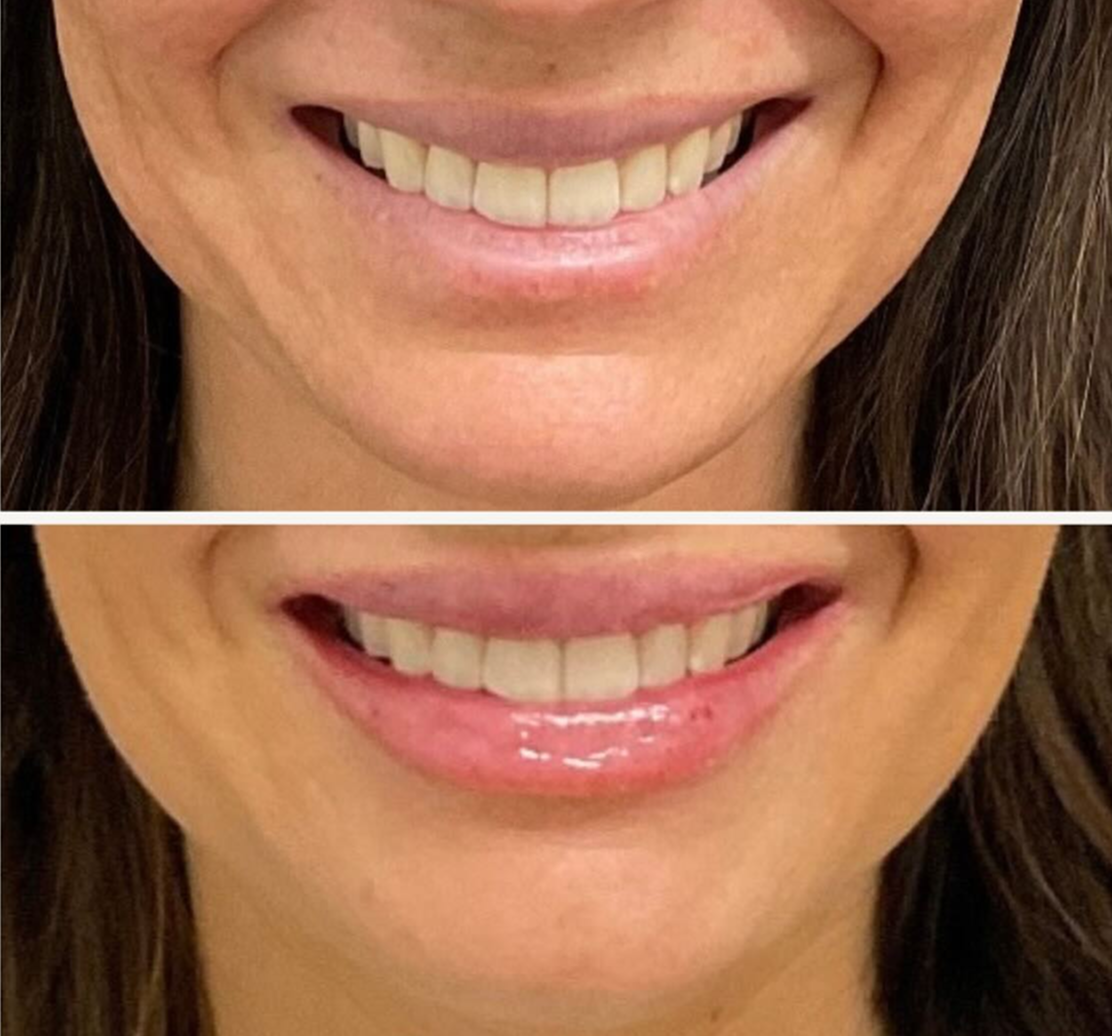 filler for lips patient 3 before & after