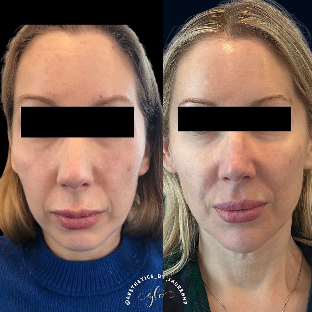 fillers before and after