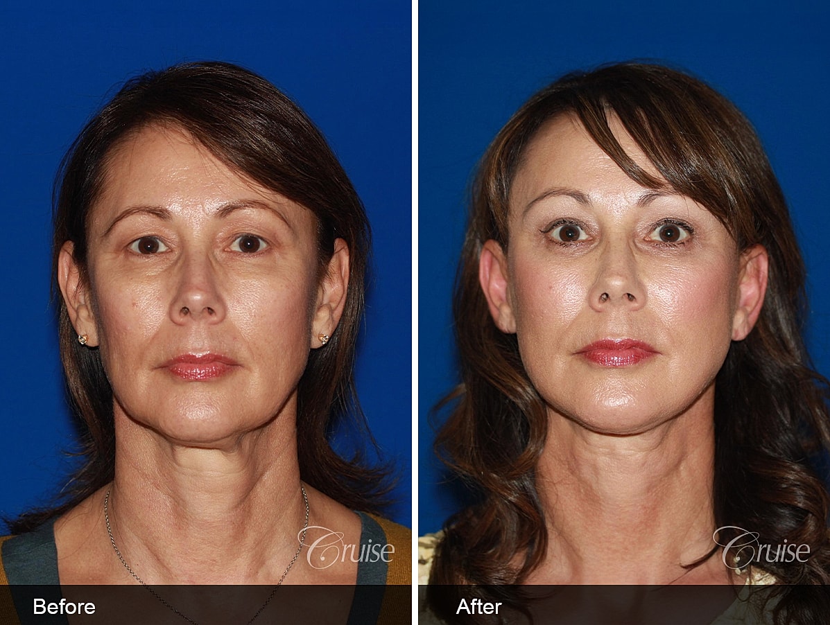 facelift before and after