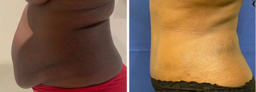tummy tuck patient 2 before & after