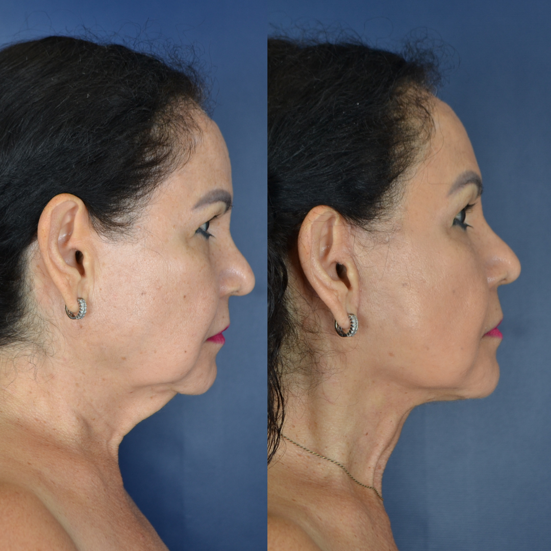 Facelift Before & after