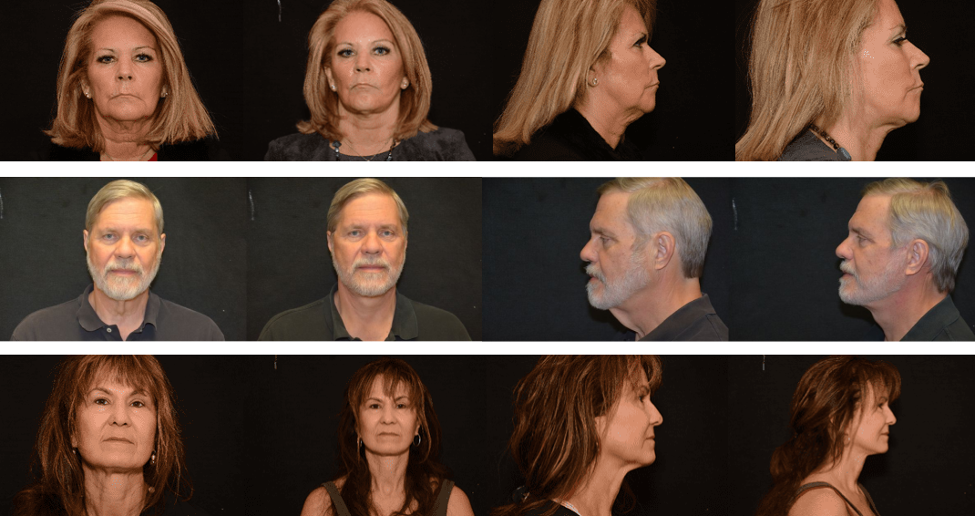 facelift surgery Patients before and after