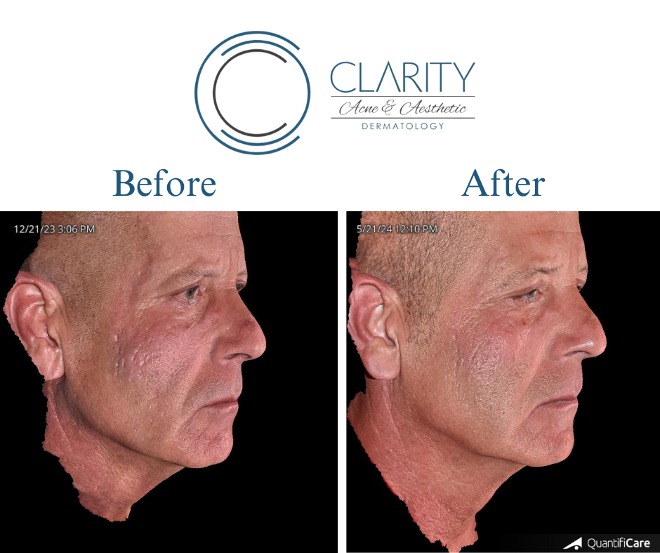 microneedling before & after