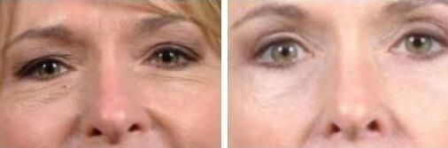patient 4 eyelid surgery before and after