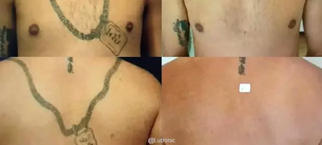 Avant/Après traitement capillaire