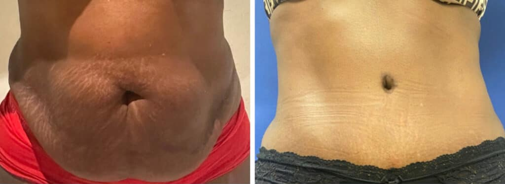 tummy tuck patient 2 before & after