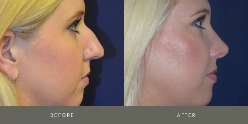 rhinoplasty before & after