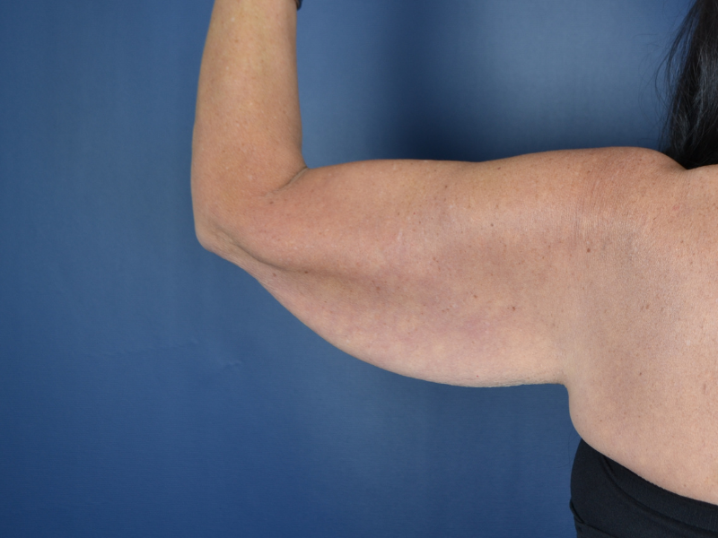 arm lift before photo