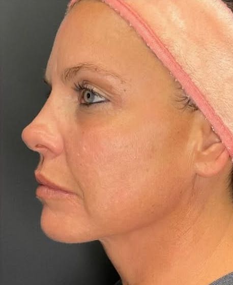 rf microneedling patient 4 after