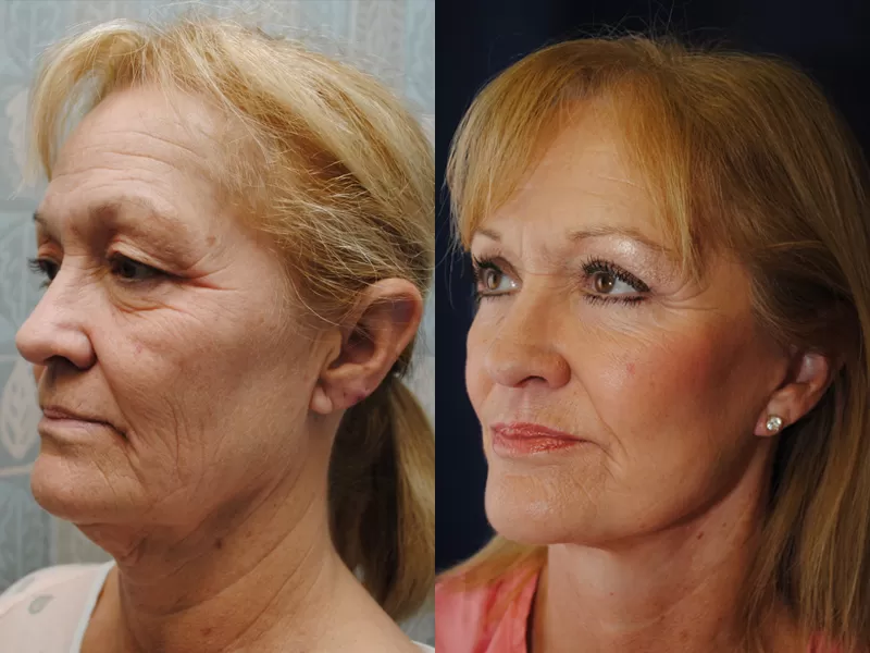 blepharoplasty before & after