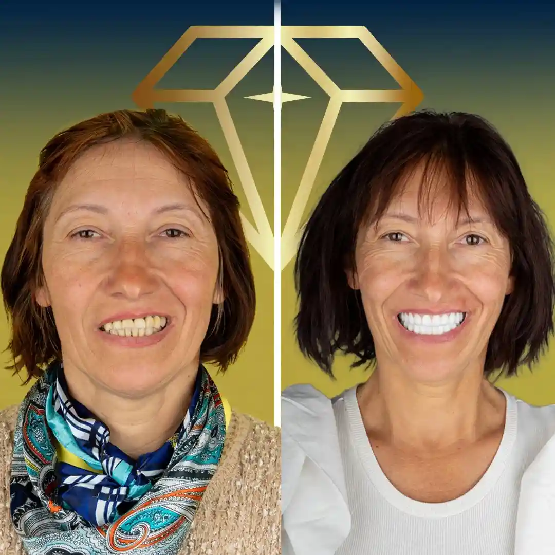 alt="Before and after dental implants transformation at Kristal Clinic"