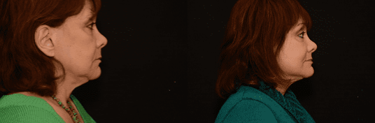 female patient 2 facelift surgery before and after