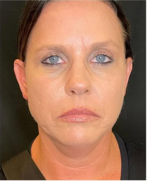 rf microneedling patient 4 before