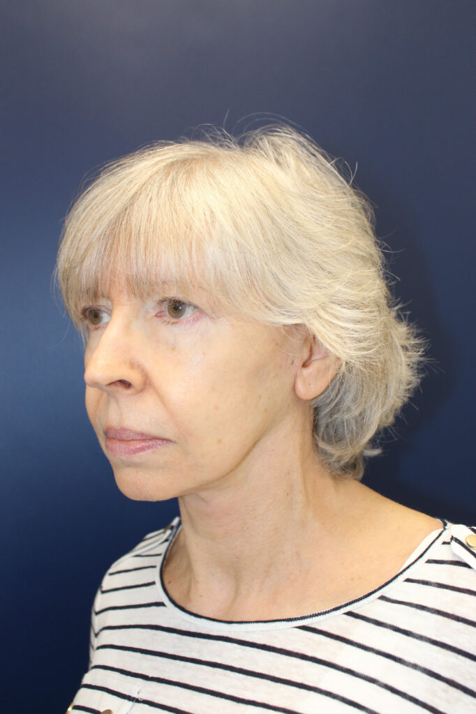 Facelift Before & after