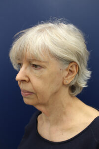 Facelift Before & after