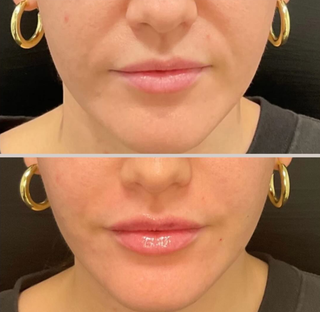 lip filler patient 4 before & after