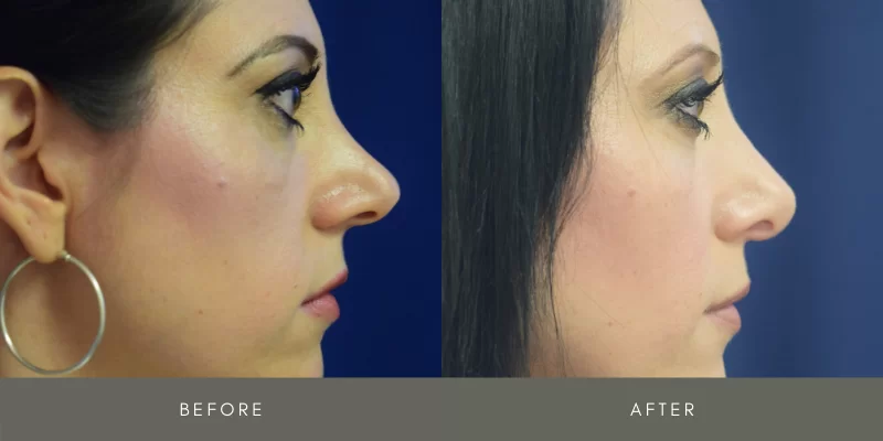 rhinoplasty before & after