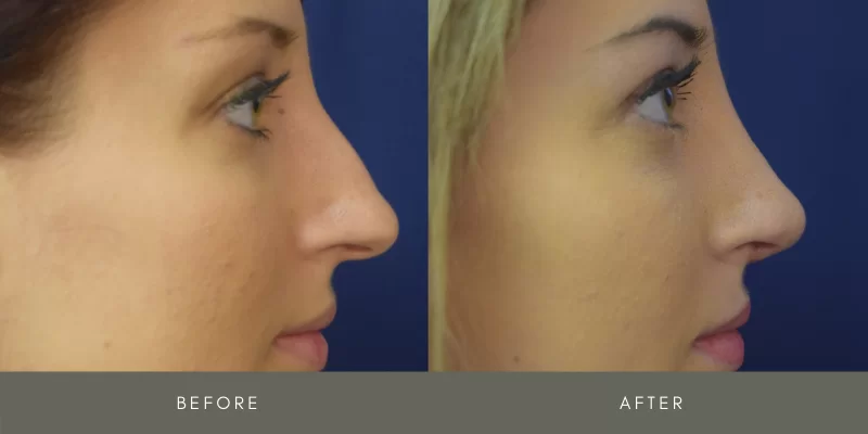 rhinoplasty before & after