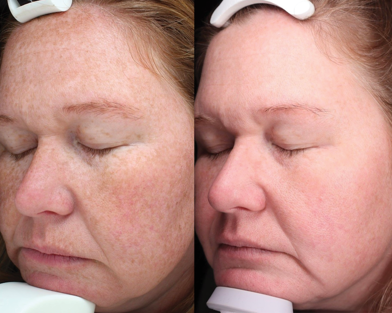 bbl before and after