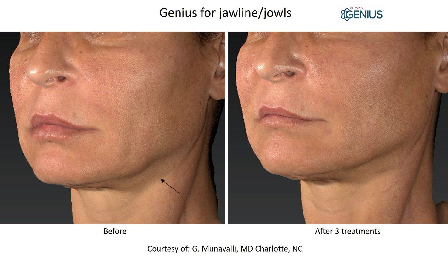 microneedling before and after