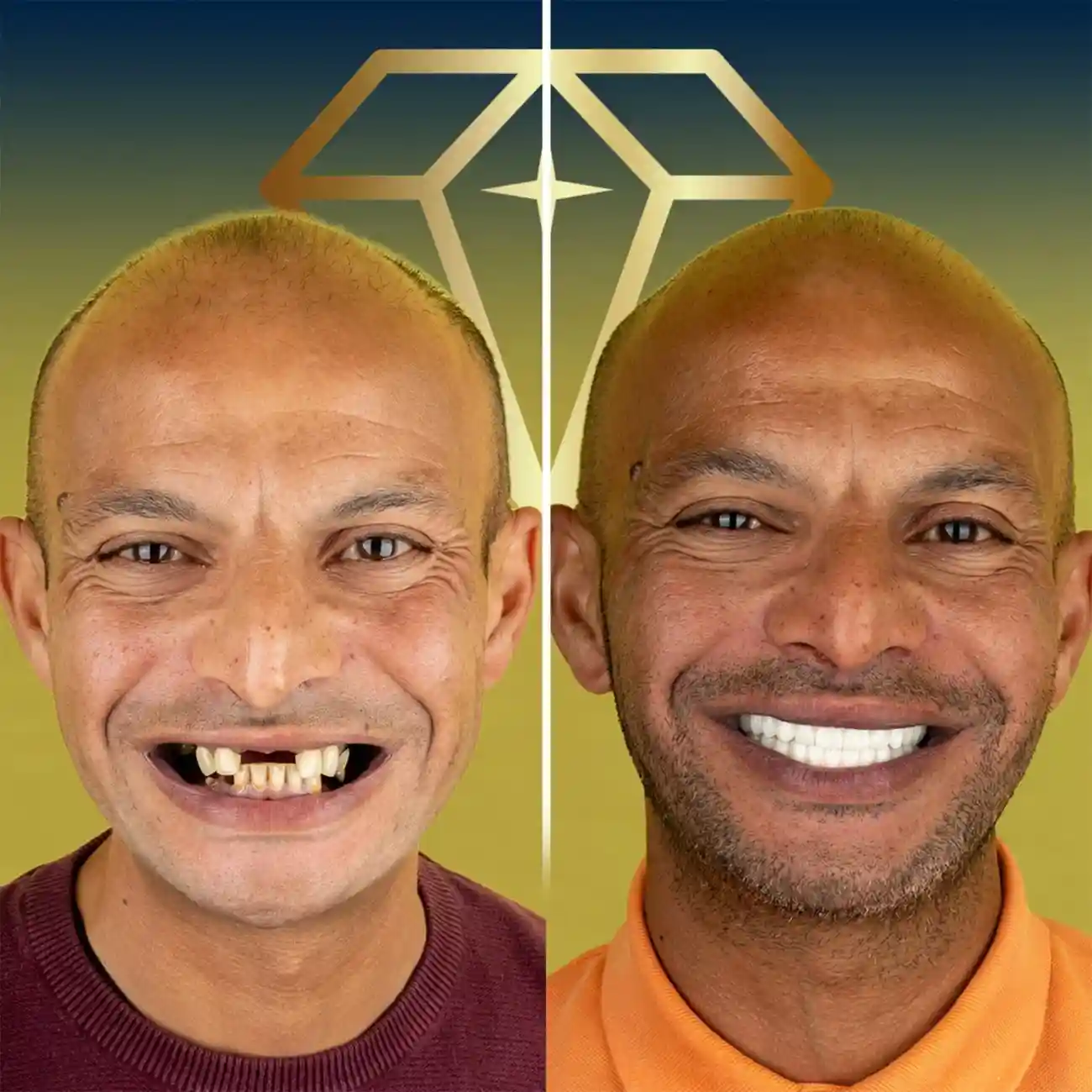 alt="Before and after dental implants transformation at Kristal Clinic"