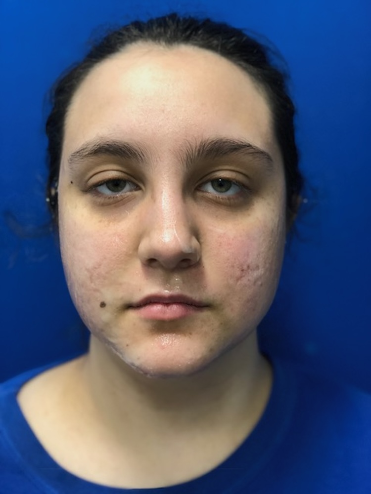 Microneedling Before