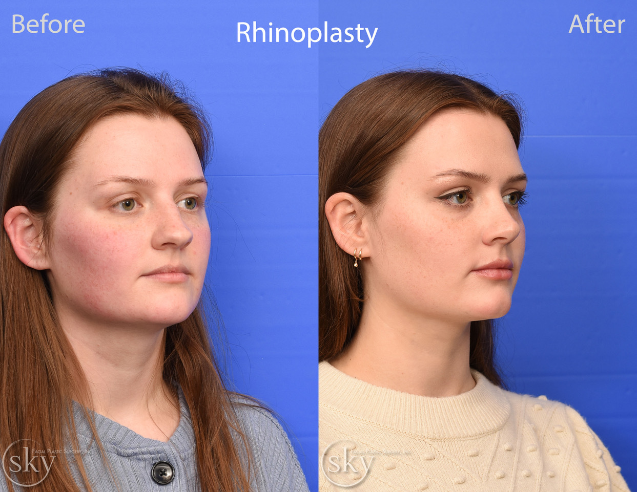 rhinoplasty before and after