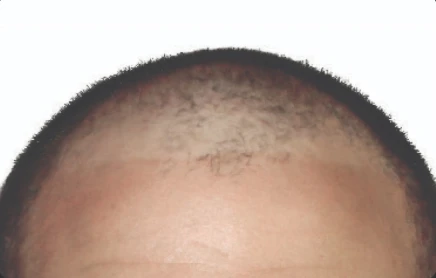 hair restoration