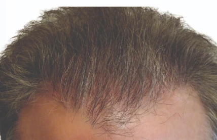hair restoration