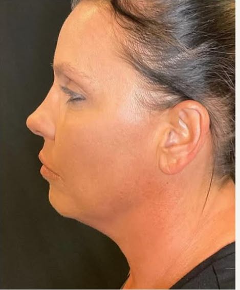 rf microneedling patient 4 before