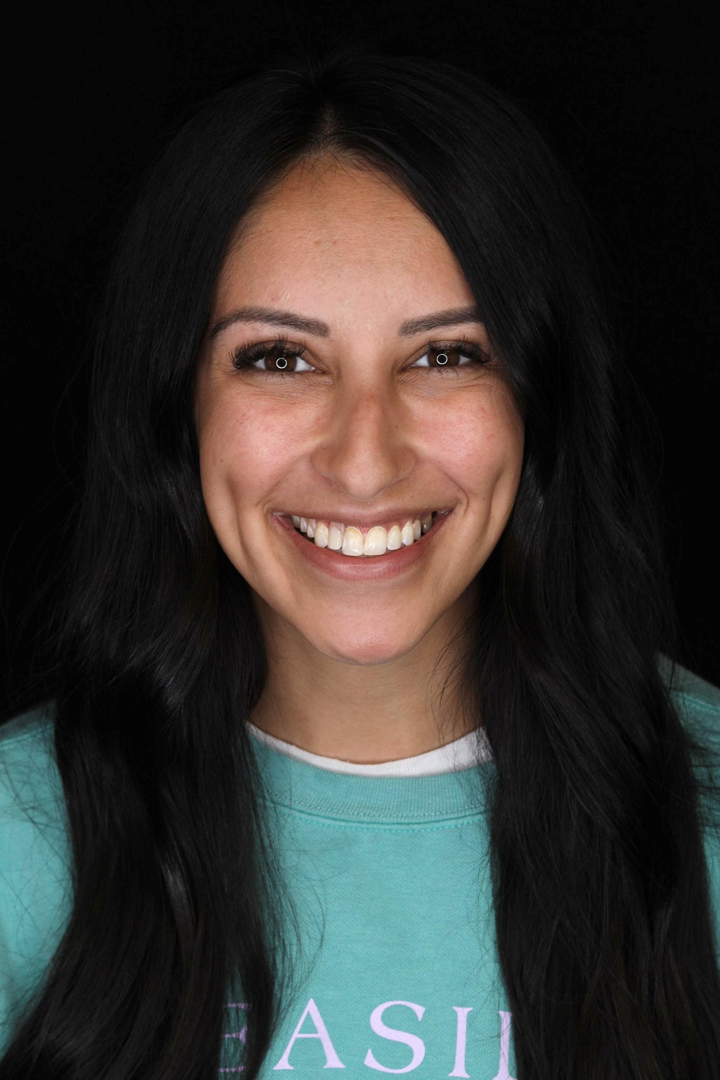 dental implants patient before