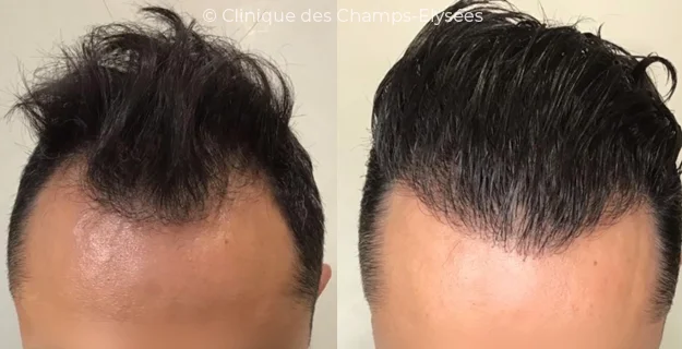 Avant/Après traitement capillaire