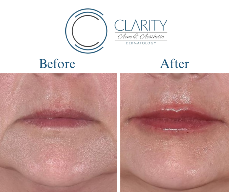 lip fillers before & after