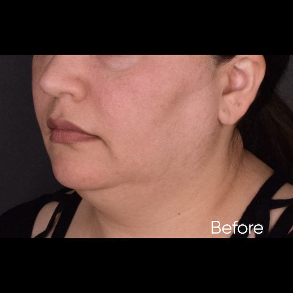facelift before & after photo