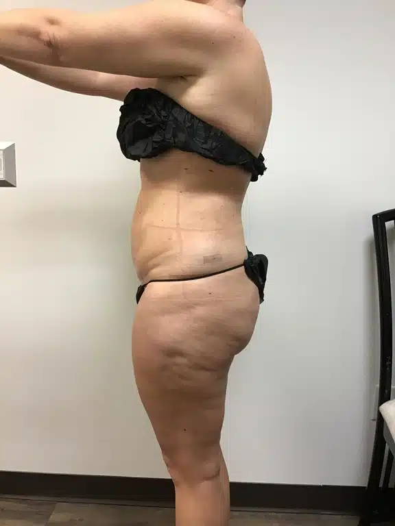 liposuction before & after patient #1