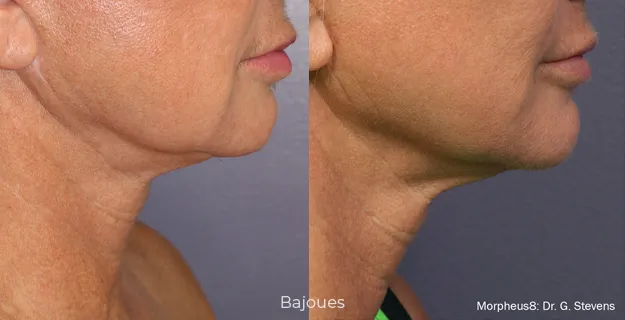 Avant/Après traitement capillaire