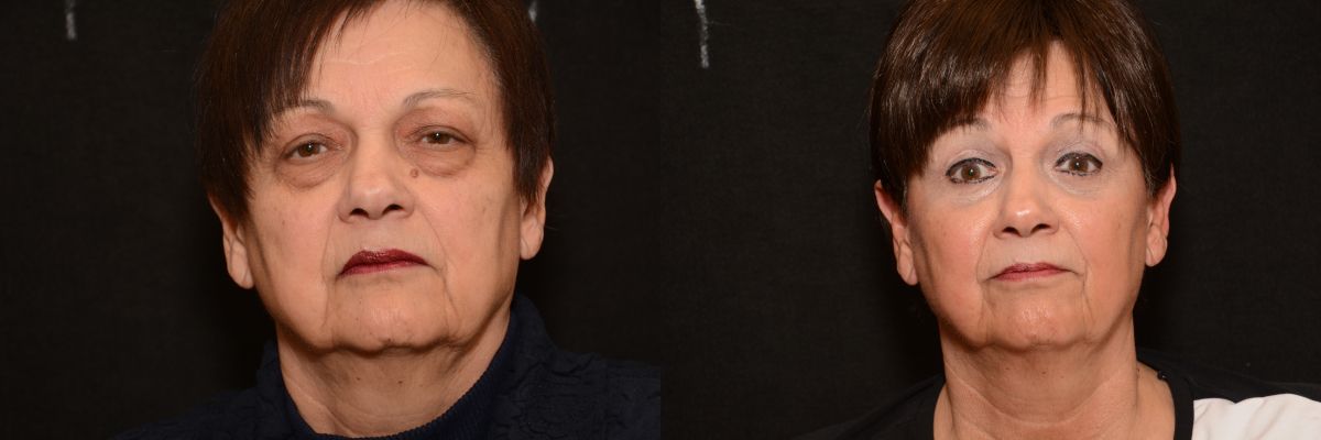 eye bag removal patient 2 before and after