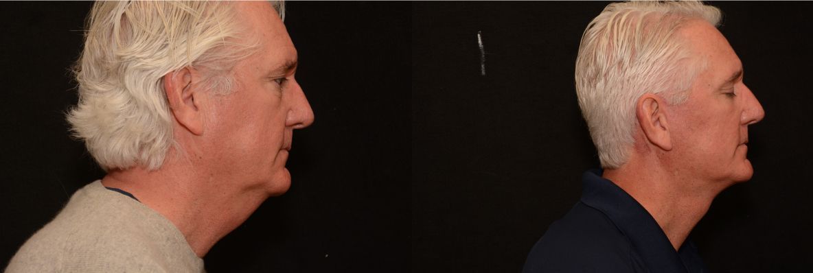 male patient 1 facelift before and after