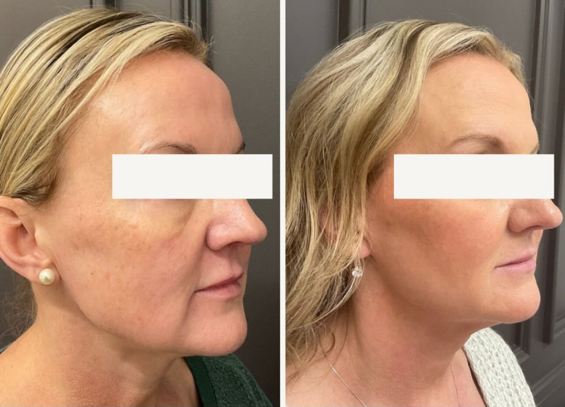 Clear + Brilliant Laser Skin Resurfacing patient 2 before & after