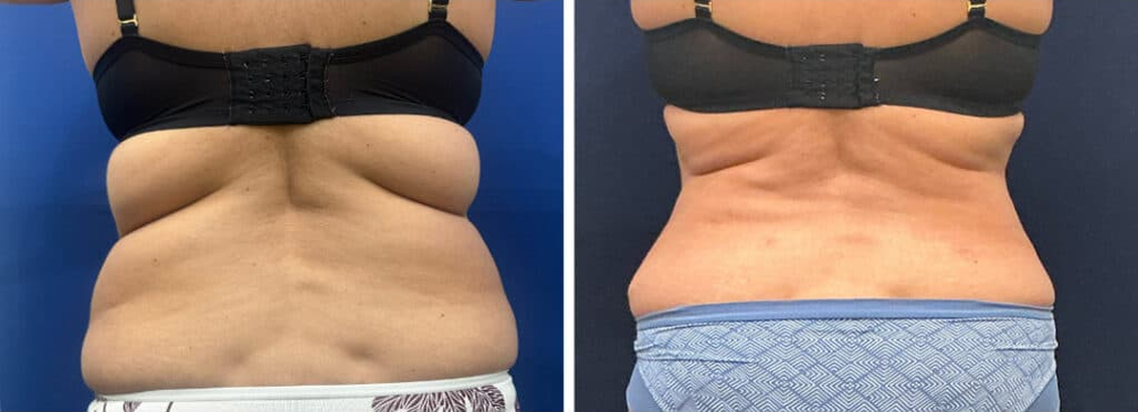 abdominoplasty patient 3 before & after