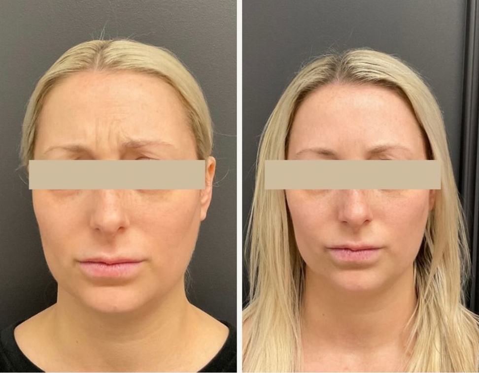 Xeomin botox patient 2 before & after