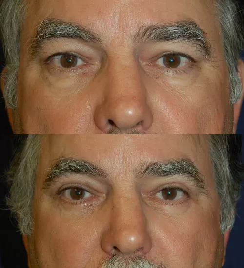 blepharoplasty before & after