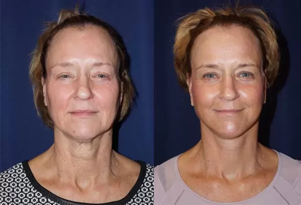 facelift and neck lift before & after