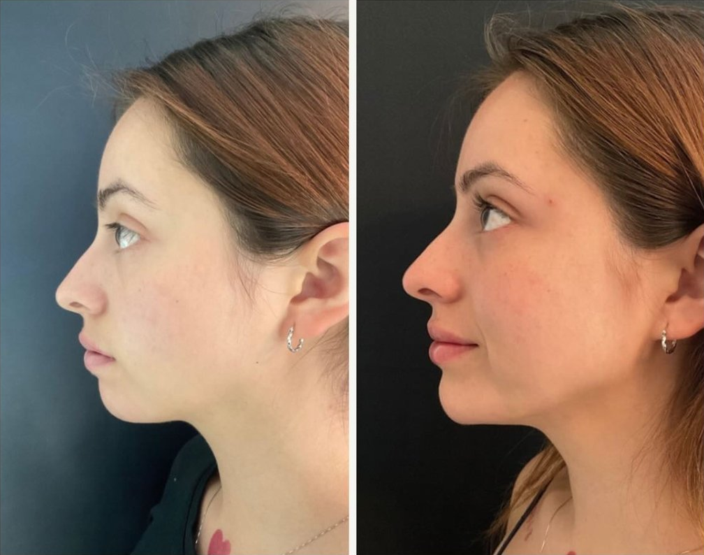 Lip, Chin, & Jawline filler patient before & after